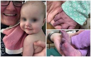 Mainile si picioarele unei fetite de 5 luni s-au albastrit la cateva zile dupa infectia cu coronavirus