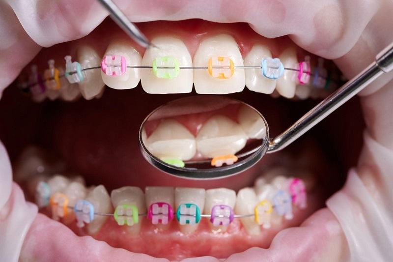Alegerea intre estetica si eficienta: O analiza comparativa intre aparatul dentar ceramic si cel metalic pentru adulti