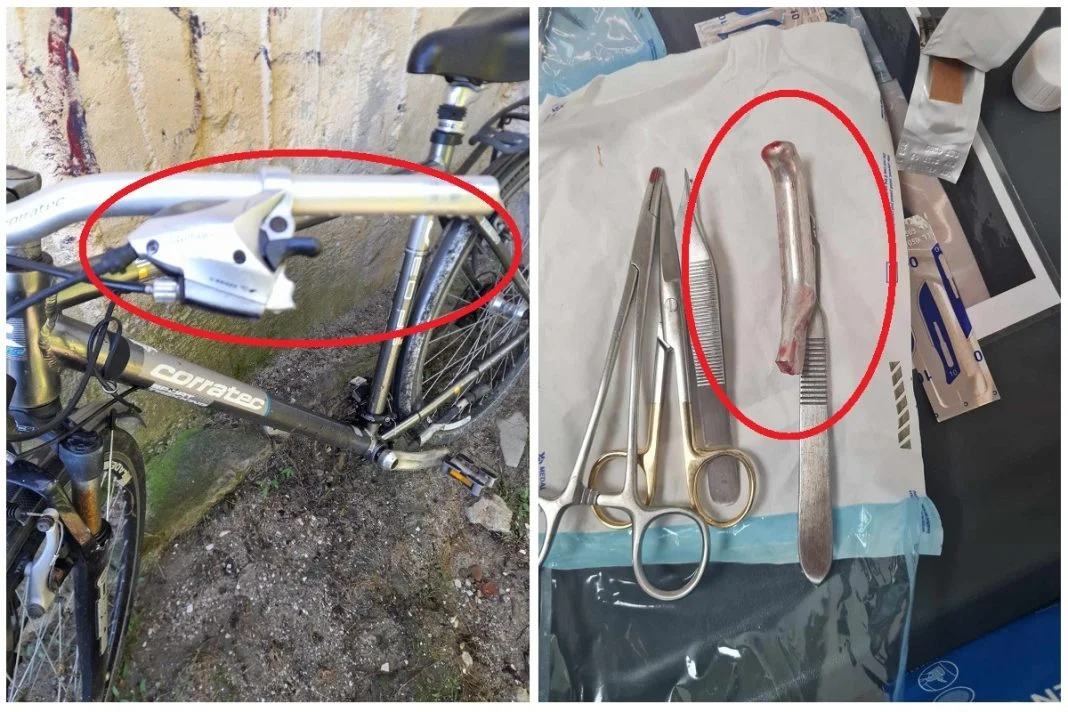 Un medic de la Spitalul Urlati a uitat un maner de bicicleta in piciorul unui pacient pe care l-a cusut