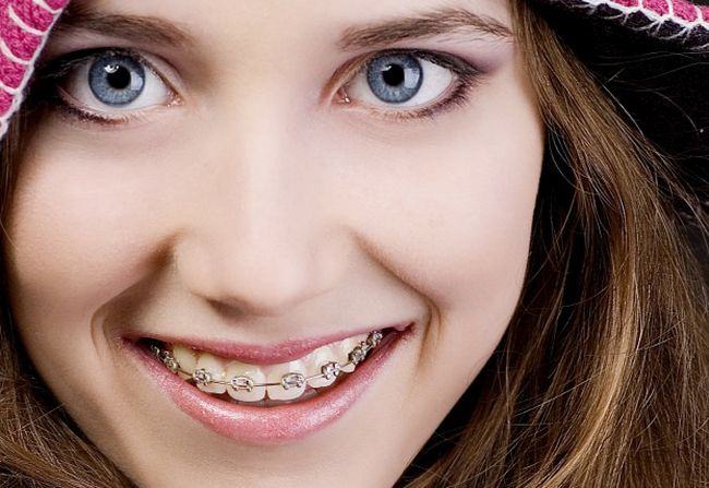 Adolescentul – cand si de care tip de aparat dentar are nevoie?