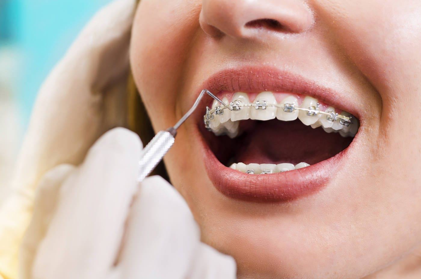 Aparat dentar metalic sau aparat dentar ceramic? Afla care sunt diferentele dintre ele!