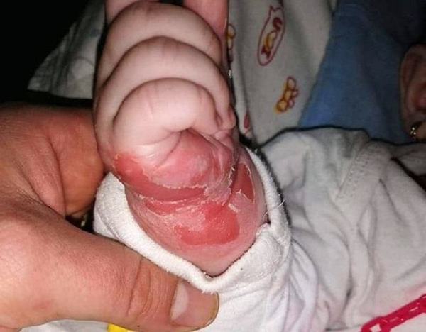 Un bebelus a plecat din spital cu rani la mana din cauza branulei. 