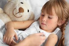 Roseola infantum, a sasea boala a copilariei: simptome, complicatii, tratament