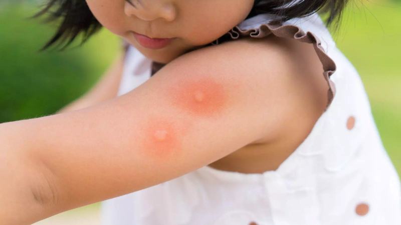 Cand devin intepaturile de insecte un pericol pentru sanatatea copiilor. Cand ar trebui parintii sa se ingrijoreze