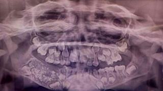 Cazul ciudat al unui copil de 7 ani caruia medicii i-au extras 526 de dinti