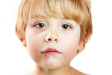 Herpesul (herpes simplex) la copii