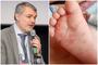 Dr. Mihai Craiu, avertisment legat de inmultirea cazurilor de sindrom mana-picior-gura. Ce sa nu dai niciodata copilul