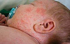 Virusul care provoaca...