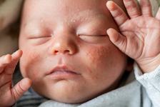3 probleme de piele la nou-nascut