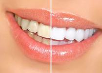 5 lucruri pe care ar trebui sa le stii inainte de albirea dentara