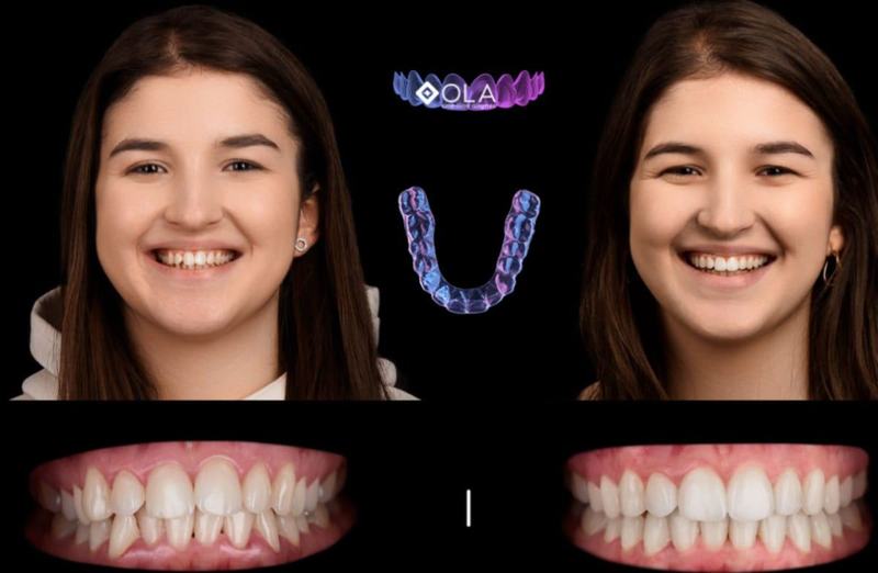 Copilul tau nu vrea sa poarte APARAT DENTAR? La Dentus•Dentino avem solutia perfecta : Aparatul Dentar Invizibil OLA KIDS