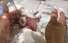 Cel mai mic baietel nascut prematur vreodata a fost externat
