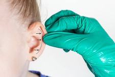 Otoplastie copii: cand este...