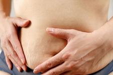 Cum poate colagenul lichid sa ajute la prevenirea vergeturilor in timpul sarcinii