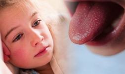 Primele simptome ale scarlatinei la copii. Cum se manifesta si cat dureaza