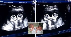 VIDEO: O ecografie arata cum se lupta gemenele in uter