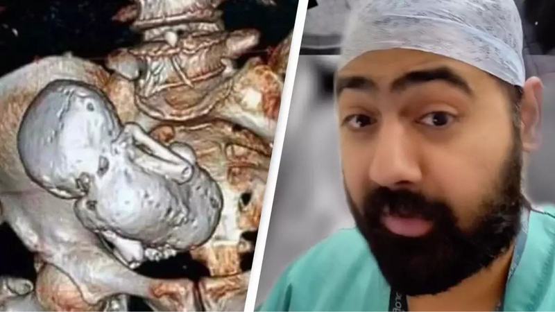 Descoperire socanta: o femeie de 82 de ani a ajuns la spital cu dureri de burta, dar medici au descoperit ca a trăit 40 de ani cu un fat calcificat in