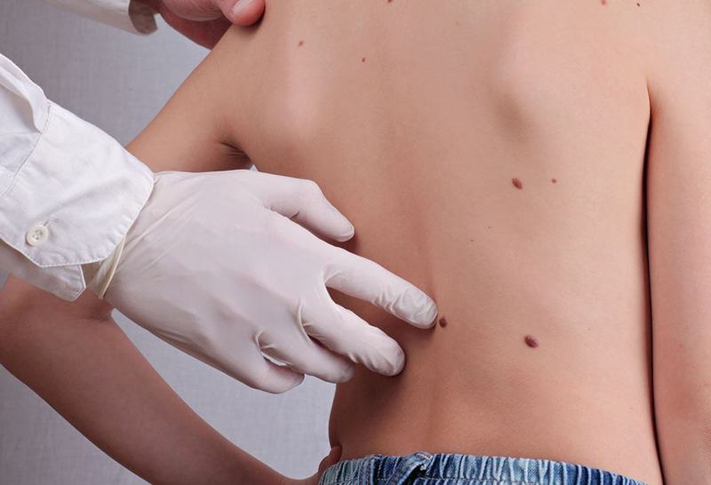 Cum sa protejezi copilul de melanom sau cancer de piele
