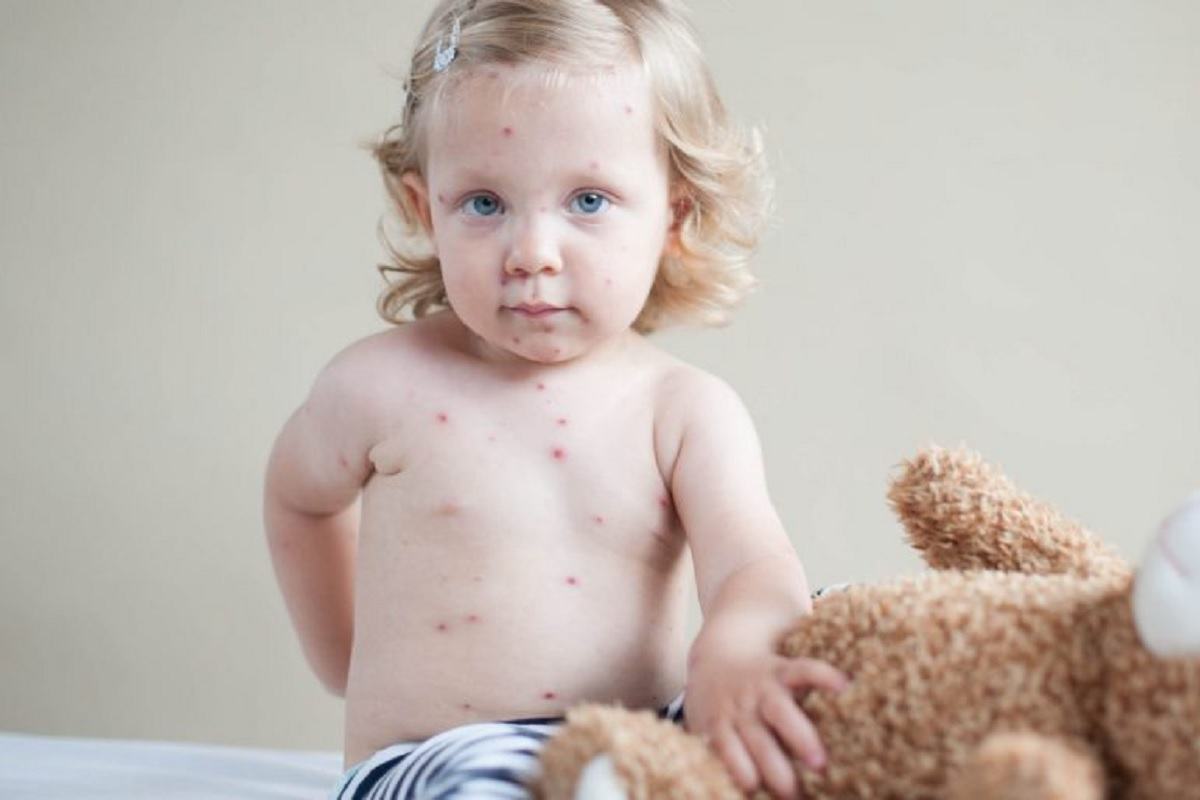 Medicamentul care nu trebuie administrat niciodata copiilor cu varicela. Efectele pot fi foarte grave